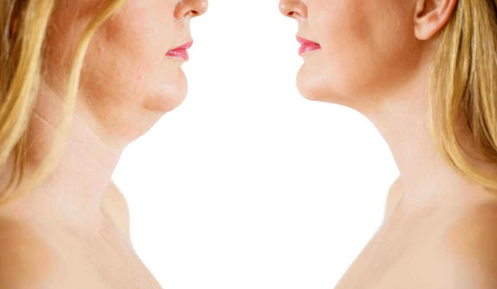 Double Chin treatment Potters Bar before and after results
