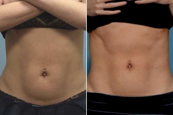 body sculpting FAQs Potters Bar