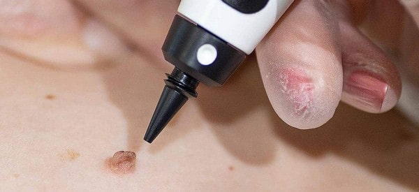 After Skin Tag Removal Potters Bar