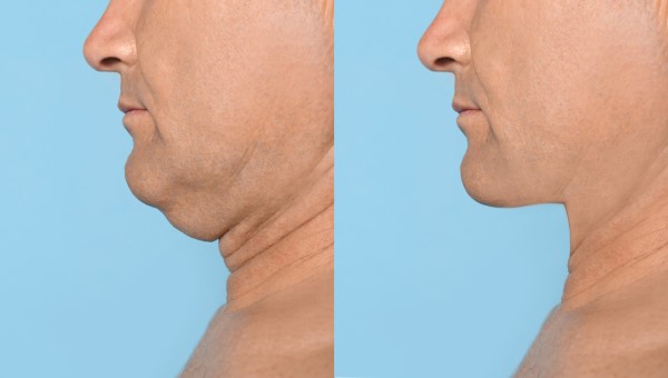 Which Non-Surgical Treatments Work Best for Jowls and Loose Skin Potters Bar?