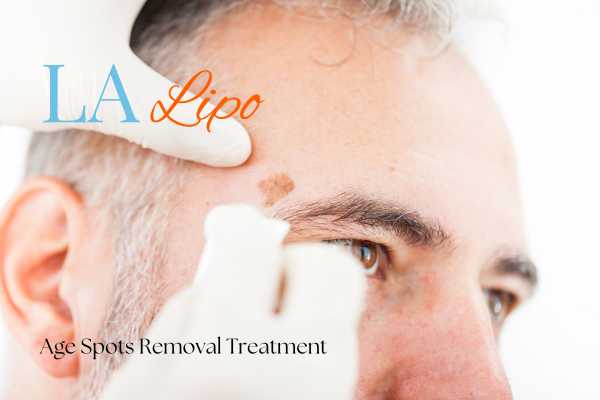 What Are the Most Effective Treatments for Age Spots Potters Bar?