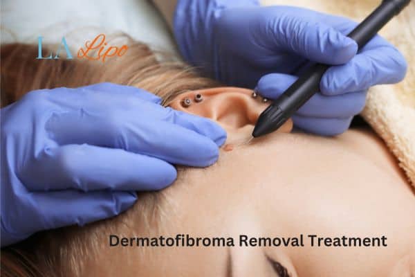Dermatofibroma Removal Treatment Potters Bar
