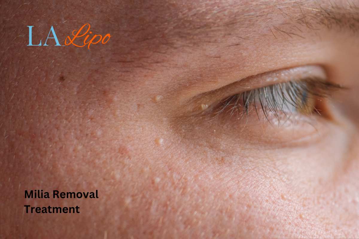Cryopen Milia Removal: Is It the Easiest and Safest Option Potters Bar?