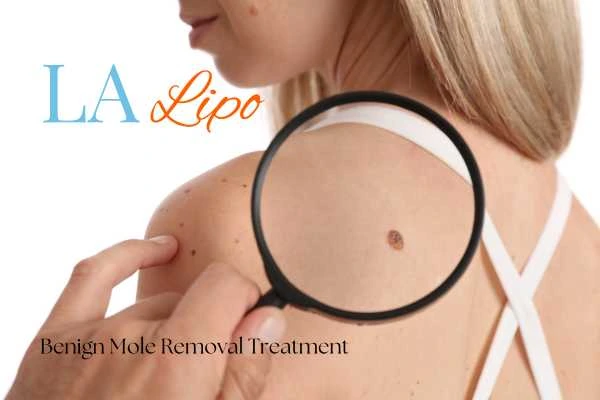 Why getting moles removed Potters Bar can boost your confidence!