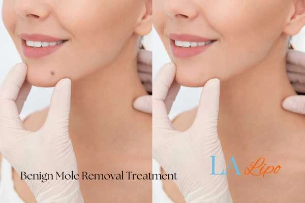 Woman's before and after results of being moles removal treatment Potters Bar