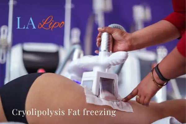 women getting fat freezing Potters Bar