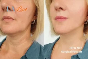 hi-fu for wrinkles Potters Bar before and after results