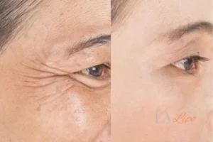 Before and after results of woman - HI-fu wrinkles reduction treatment Potters Bar