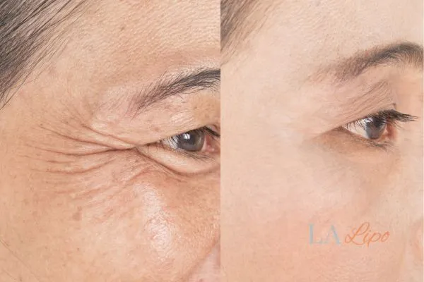 Before and after results of woman - HI-fu wrinkles reduction treatment Potters Bar