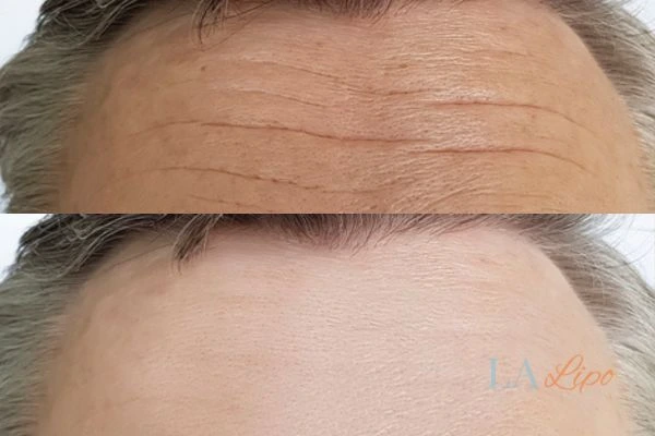 results of HIFU Potters Bar on mans forehead to help reduce lines and wrinkles