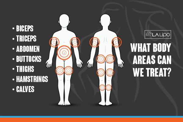 Graphic to show areas you can have LA-EMS Body Sculpting Potters Bar treatment.