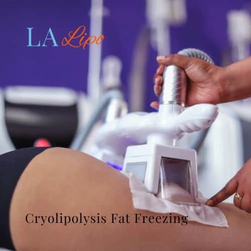 fat freezing - Cryolipolysis Potters Bar