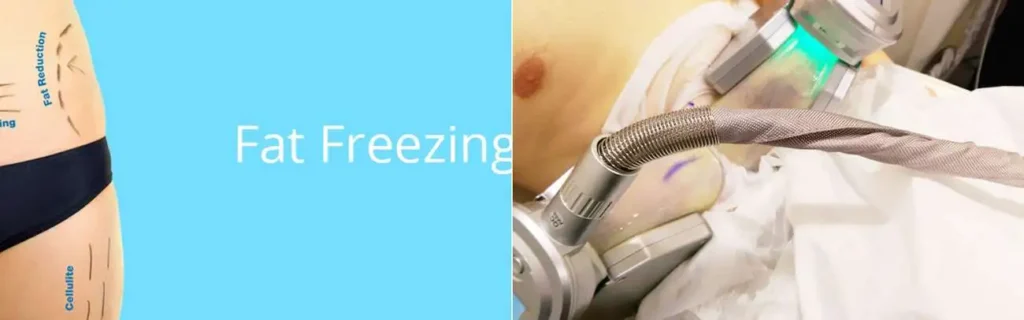 Fat freezing Potters Bar on multiple areas of the body