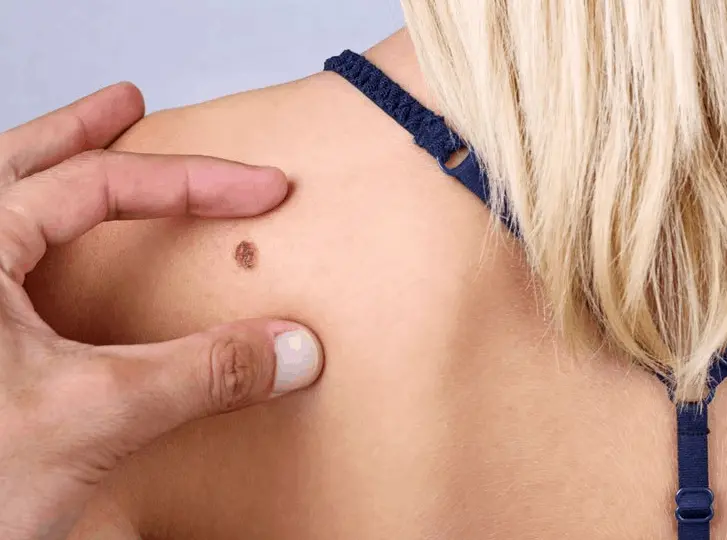 woman having mole removal Potters Bar consultation before treatment.