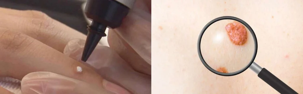 Person getting moles removed with cryopen Potters Bar