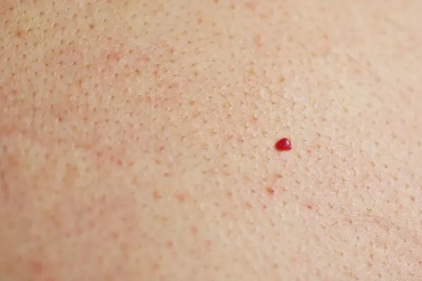 close up of a cherry angioma Potters Bar