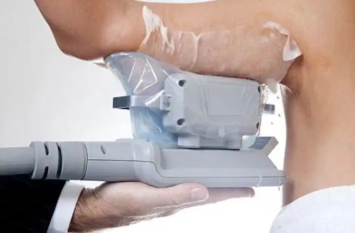 Picture of fat freezing Potters Bar on the upper arms.