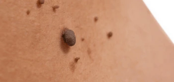 image of a skin tag Potters Bar