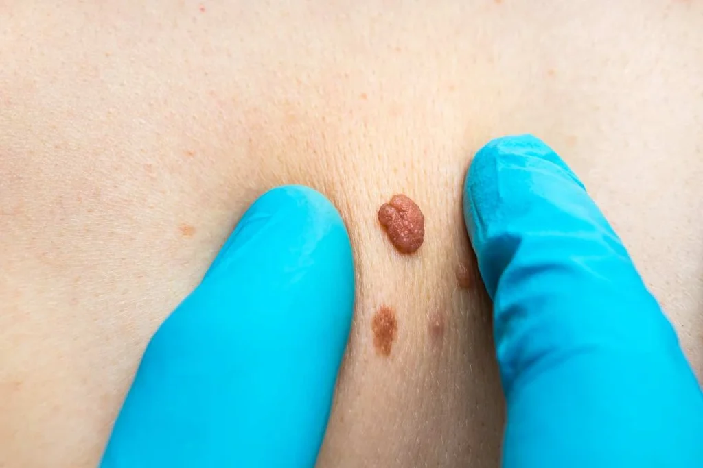 Consultant examining a skin tag Potters Bar