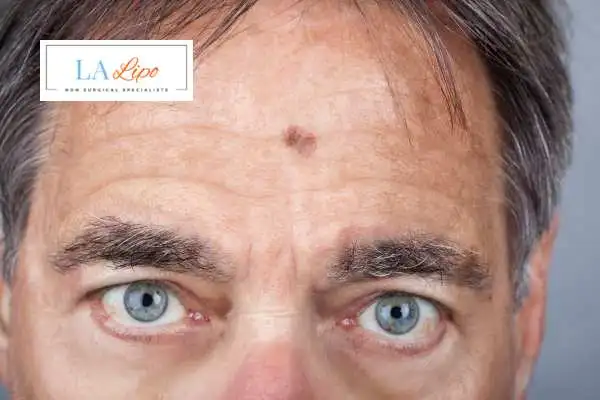 Solar Lentigo Removal Potters Bar image of man with mark on his forehead
