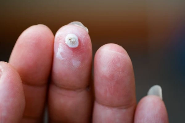wart on person finger - cryotherapy to treat from LA LIPO Potters Bar