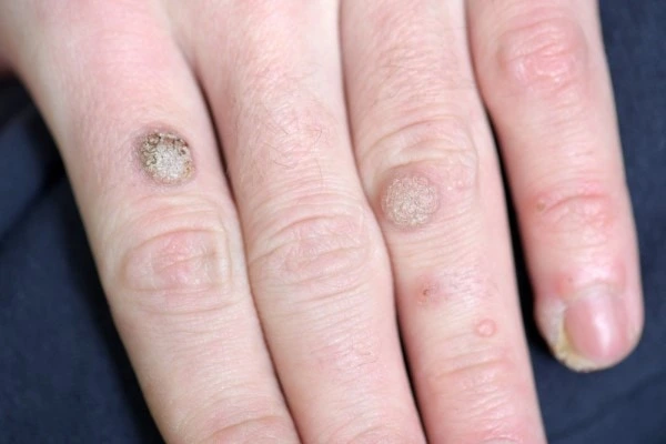 photo of warts on person hand - see wart removal Potters Bar from LA LIPO
