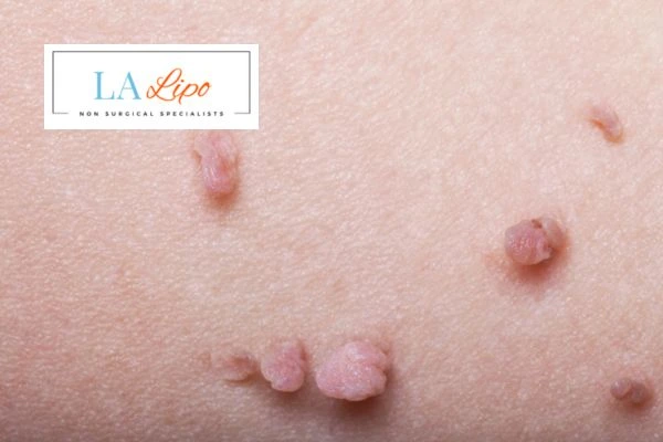 Does cryopen skin tag removal Potters Bar hurt? Find out now call our team today!