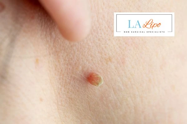 Book skin tag removal Potters Bar today speak to our team now!