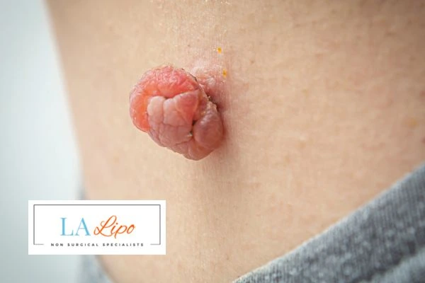 Interested in skin tag removal Potters Bar? Concerned about the pain? Find out more today!