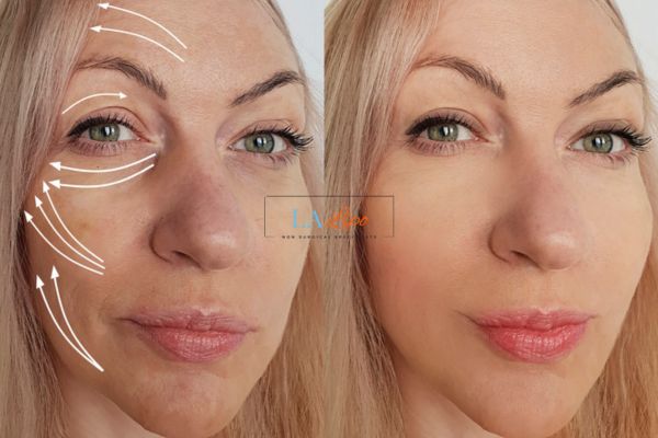 Morpheus 8 results Potters Bar face lift.
