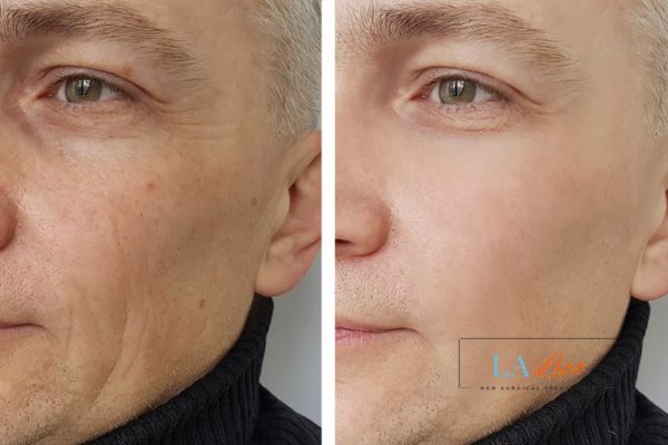 See the amazing results of Morpheus8 Treatment Potters Bar!