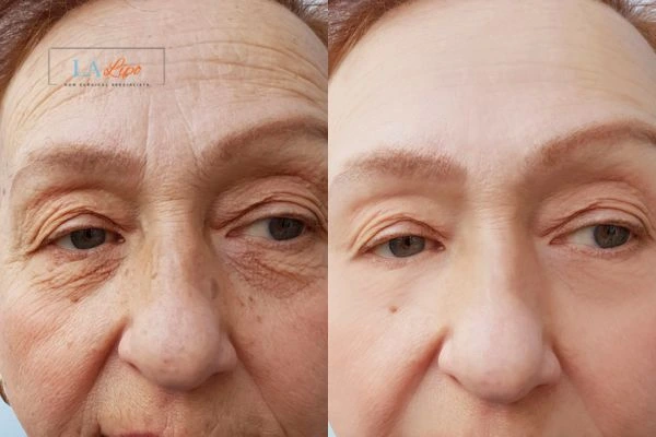The powerful benefits of Morpheus8 Treatment Potters Bar - Call Our team today!