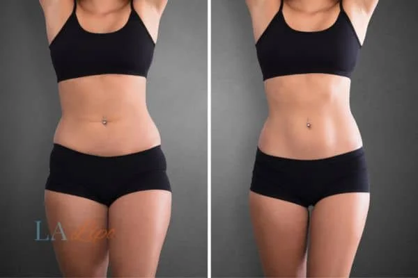 before and after results of non-surgical treatment to help a woman's body image and mental health Potters Bar