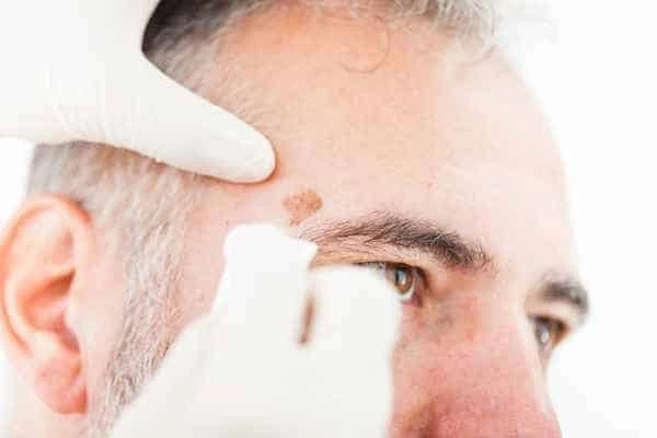 Age spots and elderly people Potters Bar what is the link?