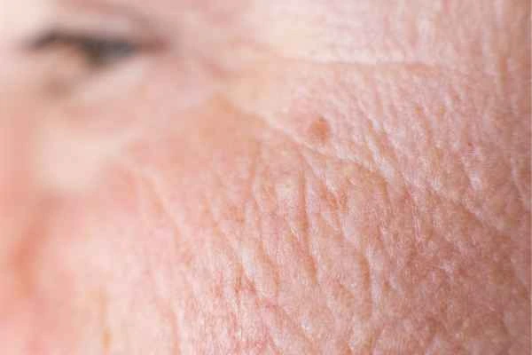 close up picture of a woman's face showing an age spot Potters Bar