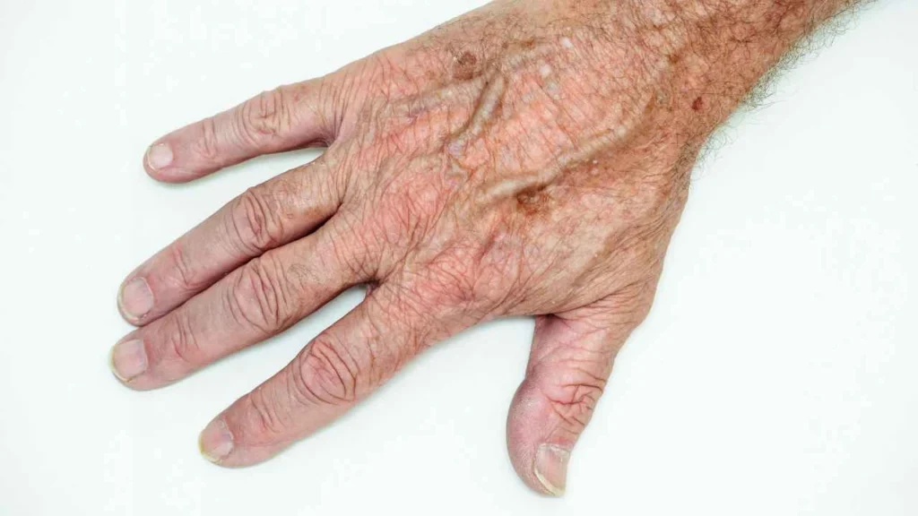 Male hand showing age spot Potters Bar