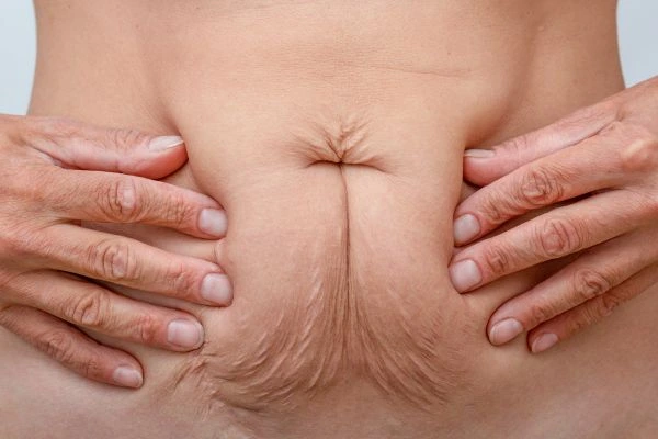 Image of a woman's stomach with loose skin - example of skin tightening Potters Bar options