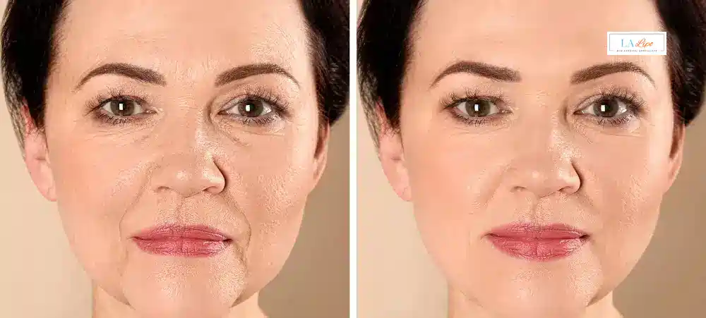 How Long Does It Take to See Results and How Long Do They Last Potters Bar?