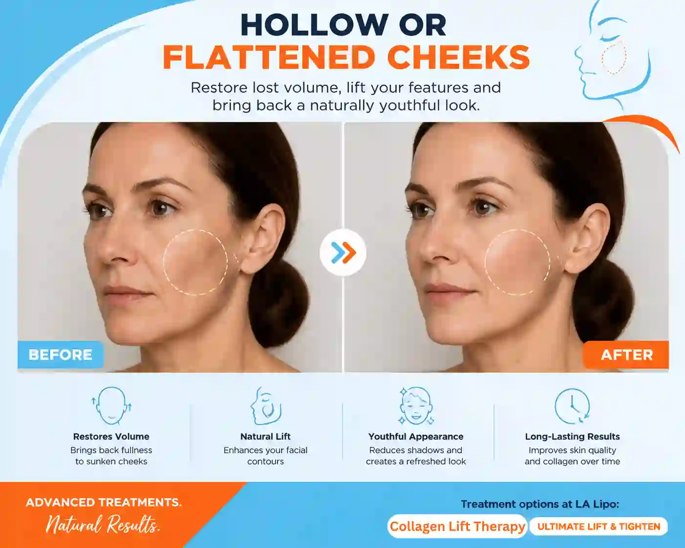 Sign #4: Hollow or Flattened Cheeks Potters Bar