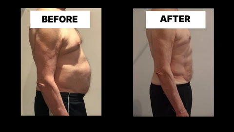 What Symptoms Can Diastasis Recti Cause in Men? Weak Core, Back Pain and Poor Posture Potters Bar